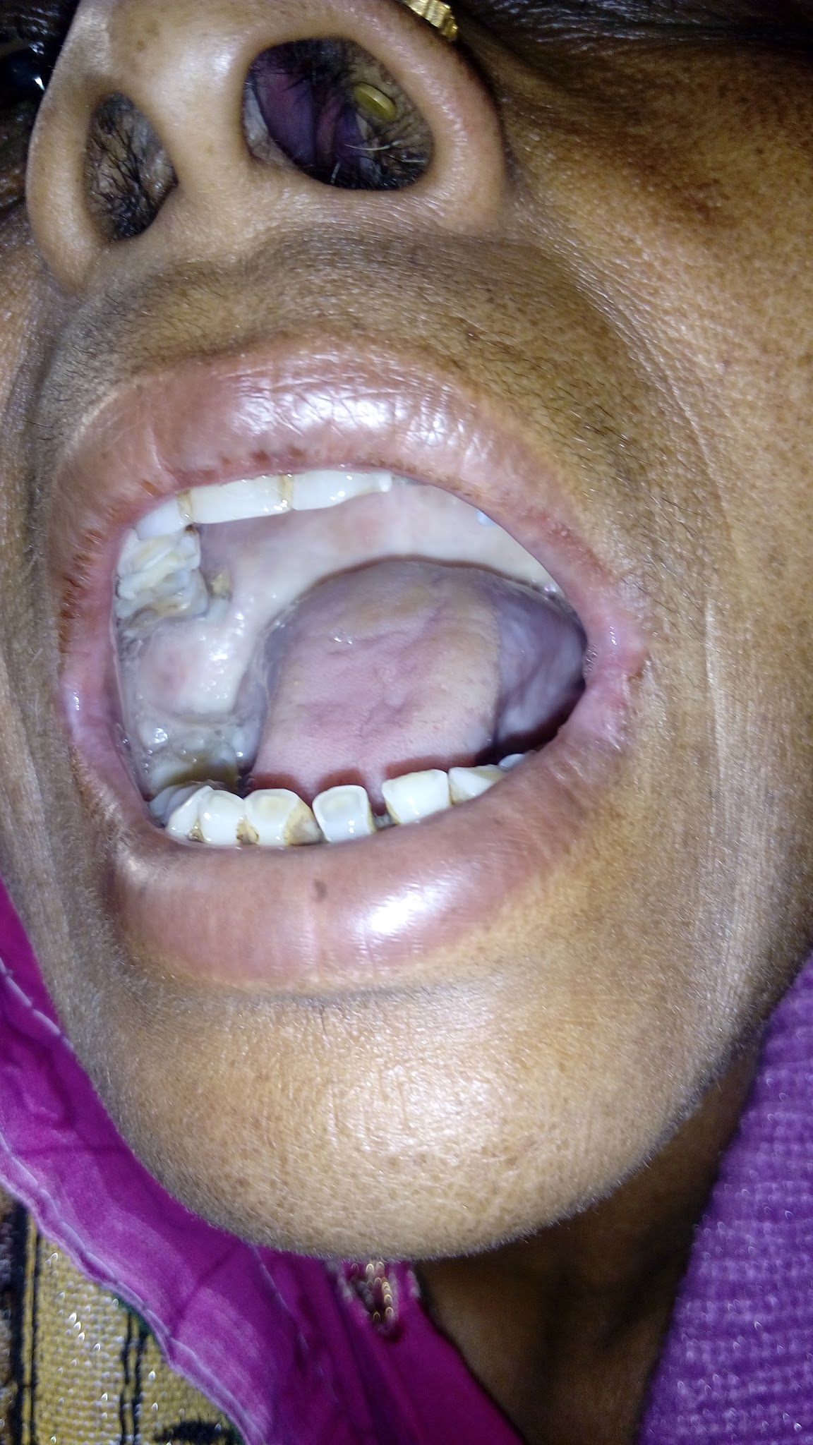 Oral Precancerous lesion tobacco related at Hathras camp on 27th Decemebr 2015
